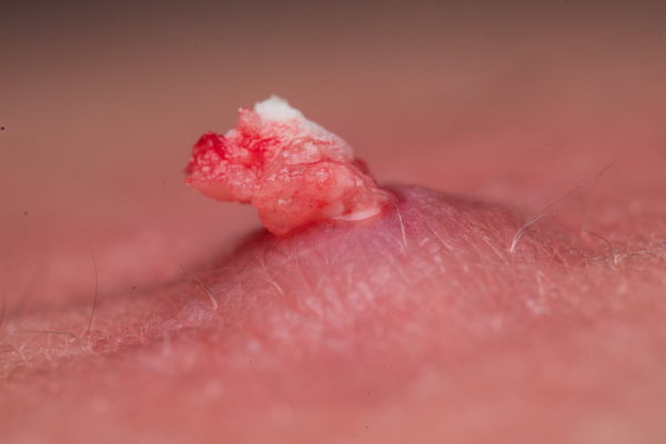Cyst Removal Treatment in Pimpri Chinchwad, Pune by Dr. Padmawar